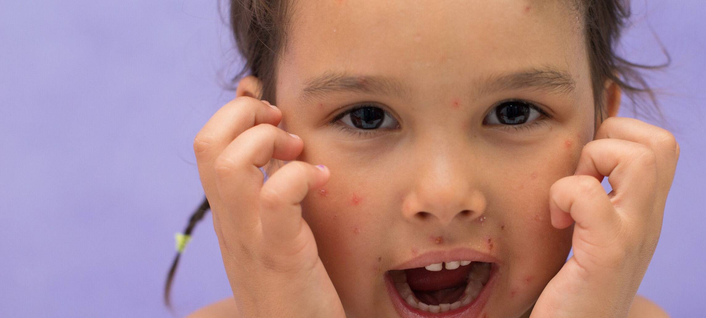 Ein Drittel weniger Windpocken-Fälle in Hamm